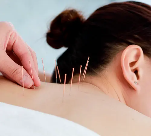 Acupuntura - Paula Pereira